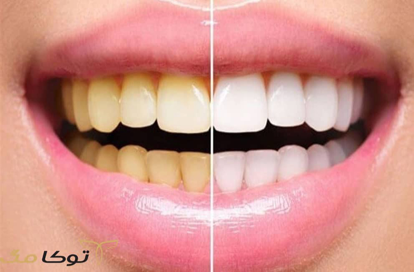 مزایای روکش لمینت با کامپوزیت چیست؟