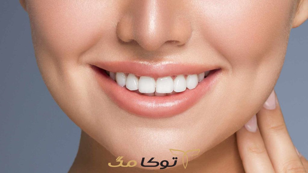 مزایا و معایب لمینت دندان