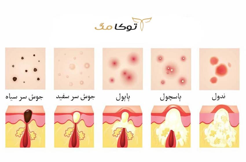جوش صورت