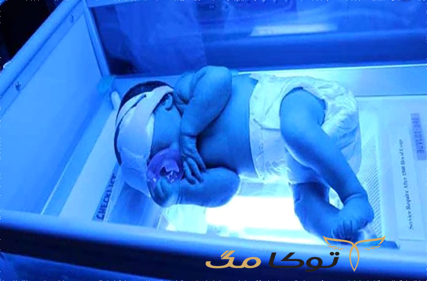 راه‎‌های درمان زردی
