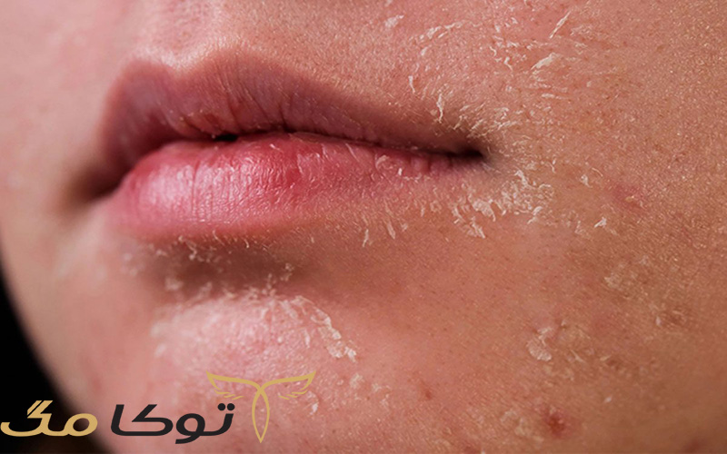 علائم و علت خشکی پوست چیست؟