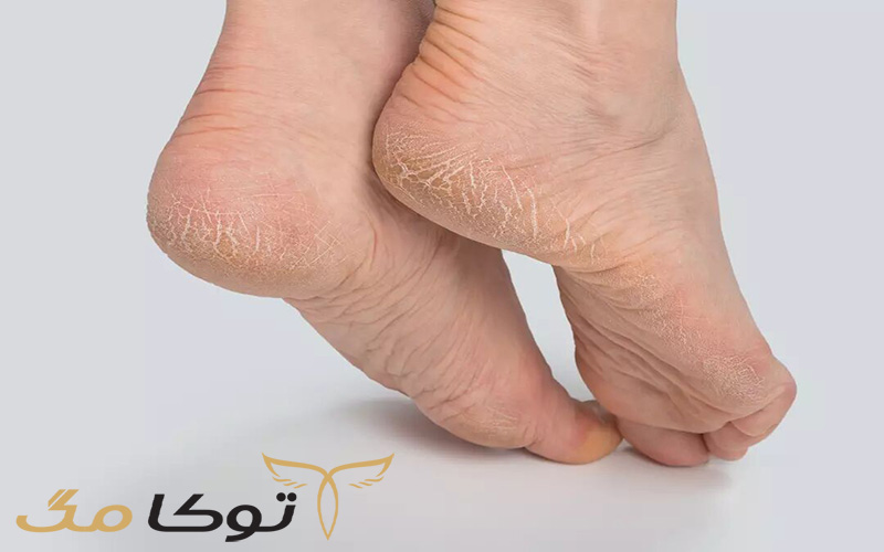 خشکی پوست پا