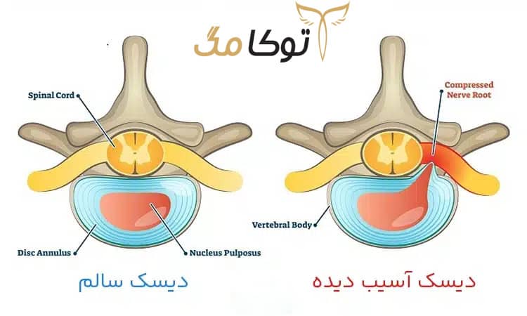 دیسک کمر کجاست؟