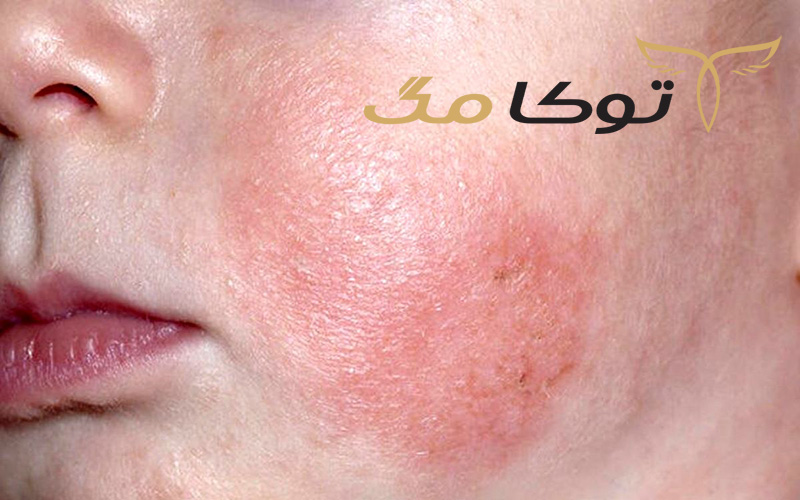 حساسیت فصلی