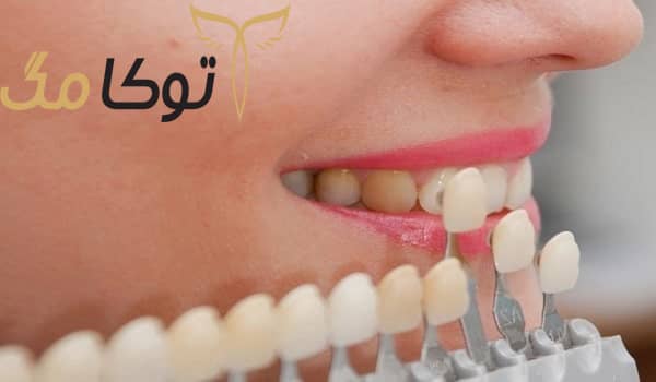 بهترین روکش دندان