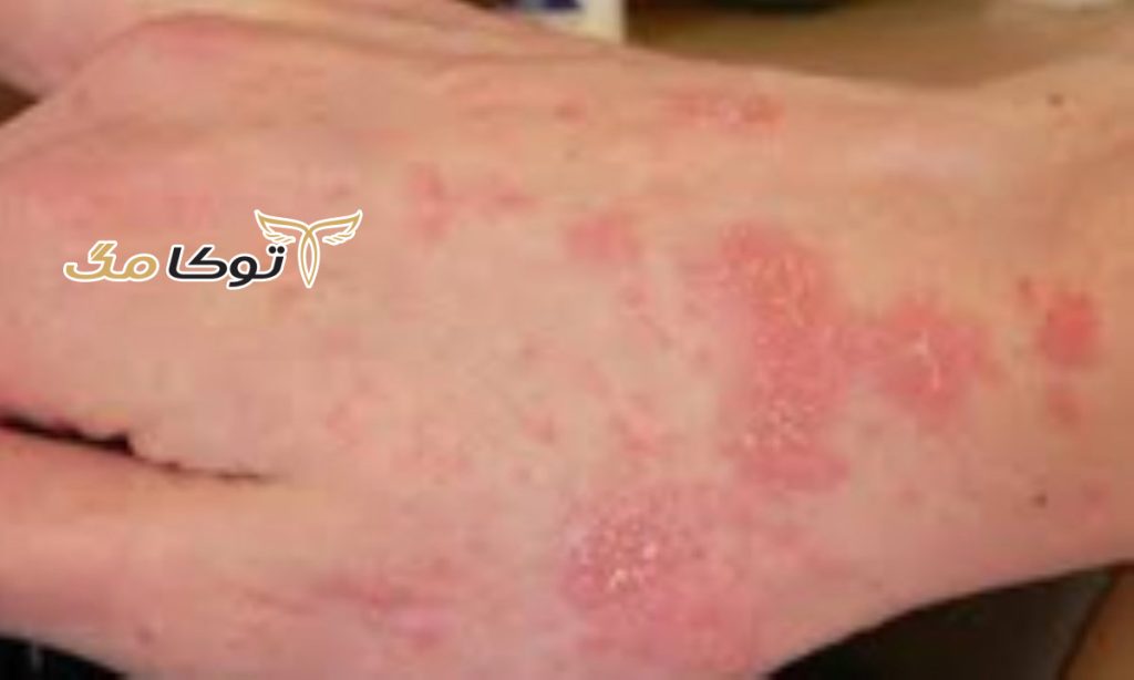 اثرات بیماری گال چیست؟