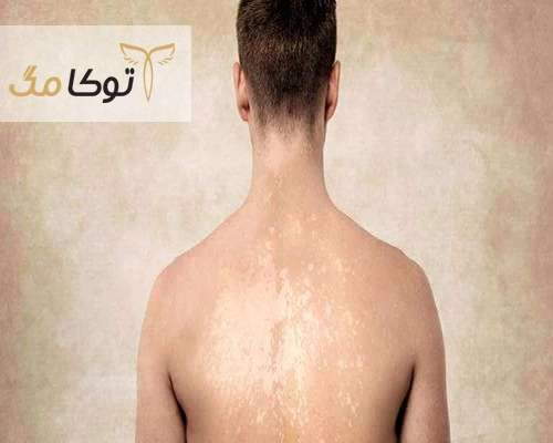 جلوگیری از پیری زودرس
