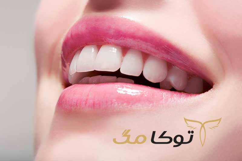 راهنمای انتخاب روکش دندان