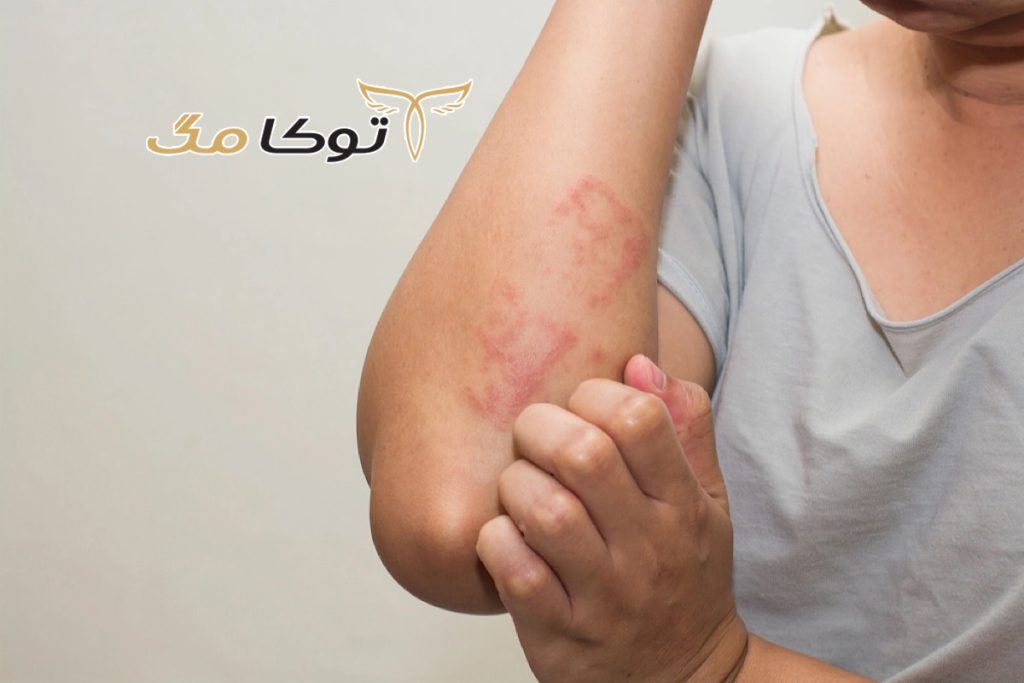 بیماری گال چیست؟