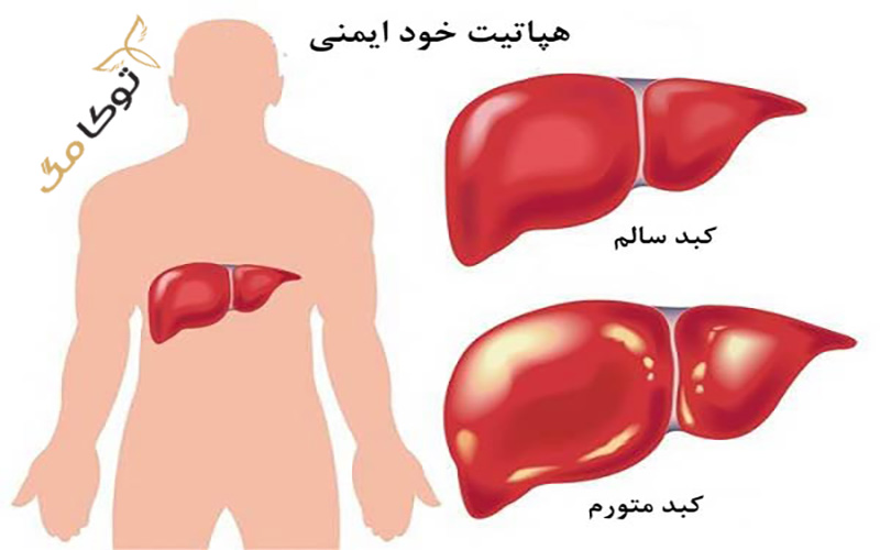 آشنایی با بیماری هپاتیت خودایمنی 