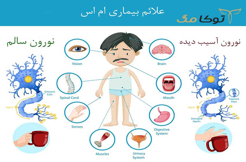 علائم بیماری MS