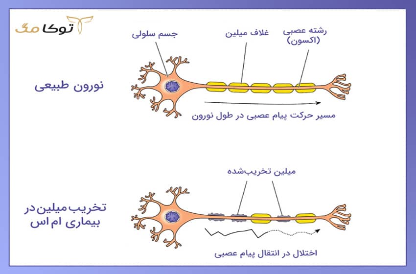 آشنایی با انواع بیماری MS