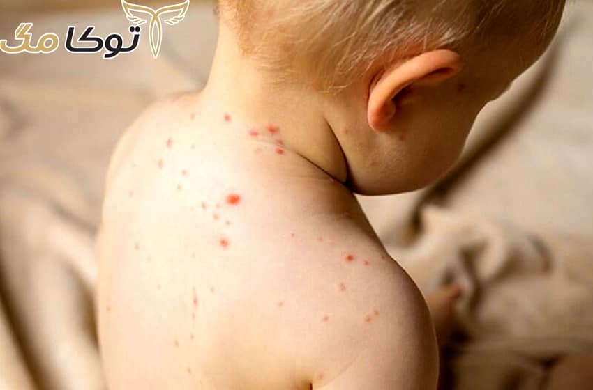 آشنایی با بیماری سرخک