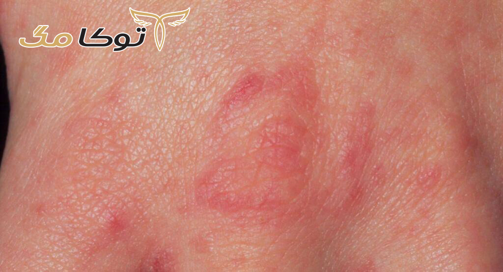 اثرات بیماری گال چیست؟
