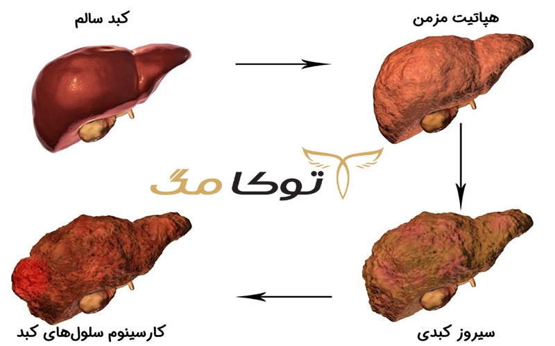 آشنایی با بیماری هپاتیت C