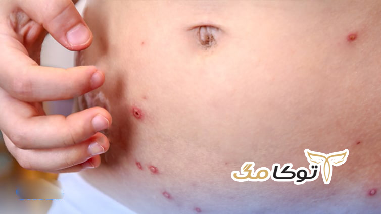 آشنای با عوارض بیماری سرخک
