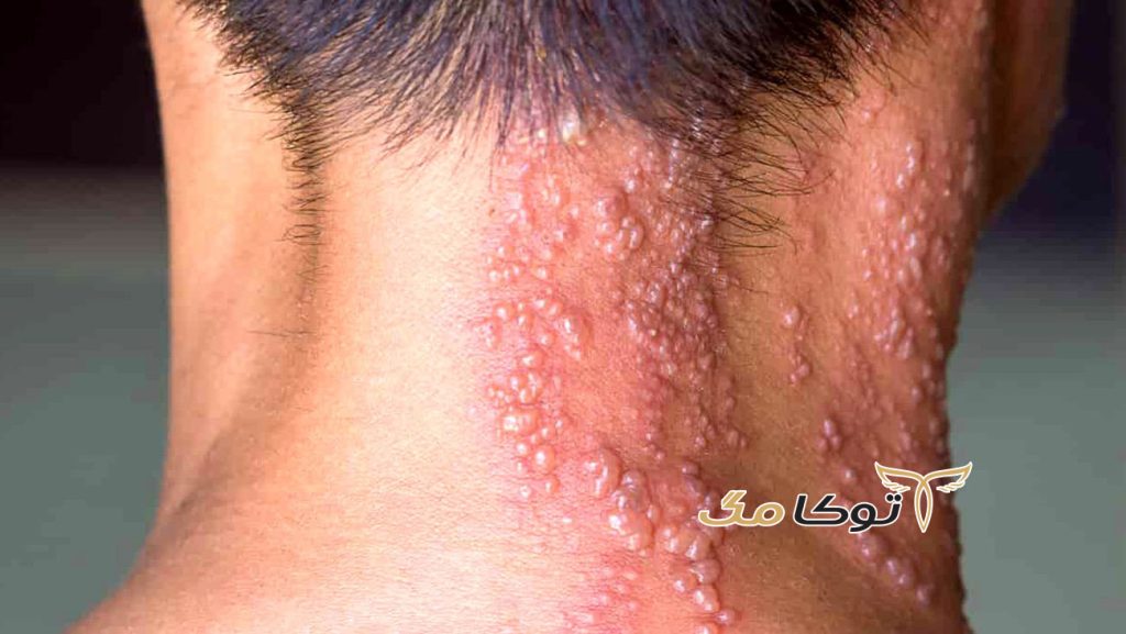اثرات بیماری گال چیست؟