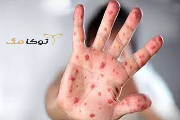 علائم و عوارض آبله میمونی