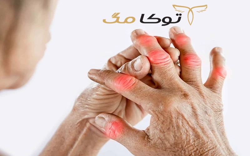 آشنایی با بیماری آرتروز دست