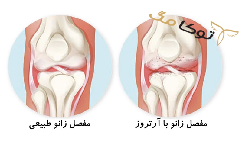 آشنایی با بیماری آرتروز
