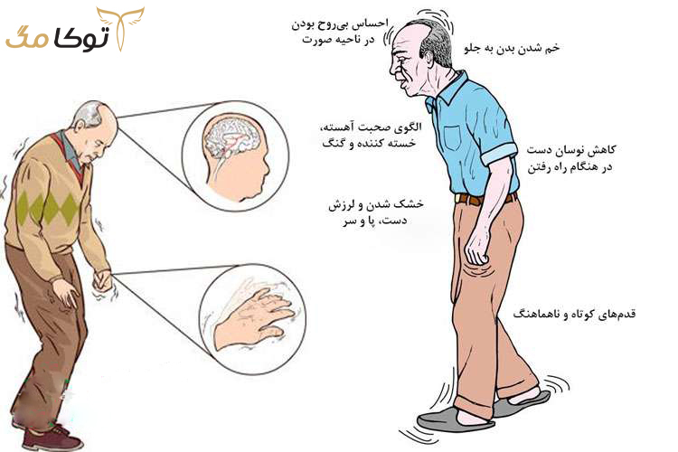 علائم و نشانه های بیماری پارکینسون چیست؟
