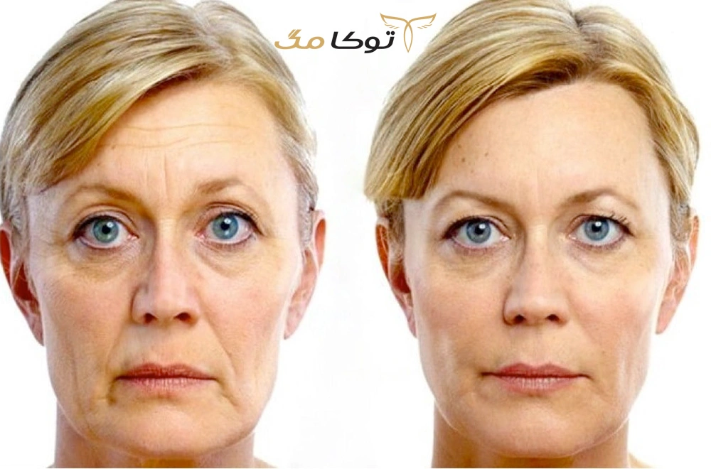 جراحی لیطف صورت برای چه کسانی مناسب است؟
