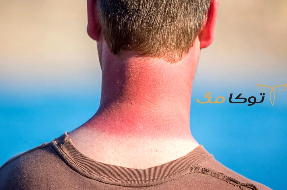آفتاب سوختگی چیست؟