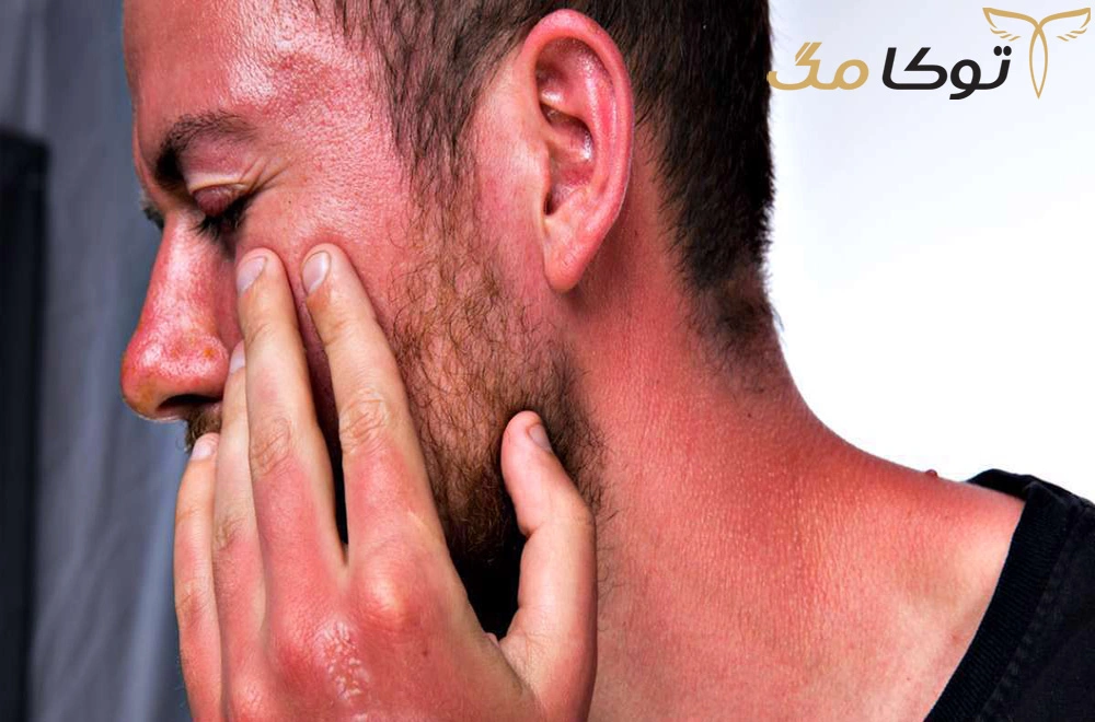 علائم آفتاب سوختگی چیست؟