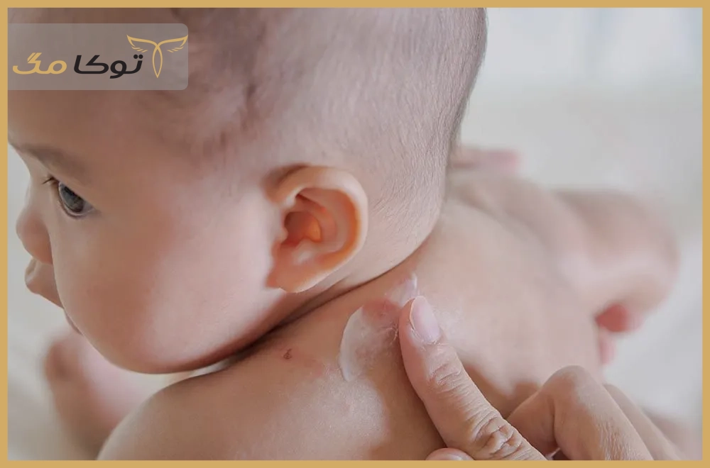 راه‌های پیشگیری از ایجاد حساسیت پوستی در نوزادان