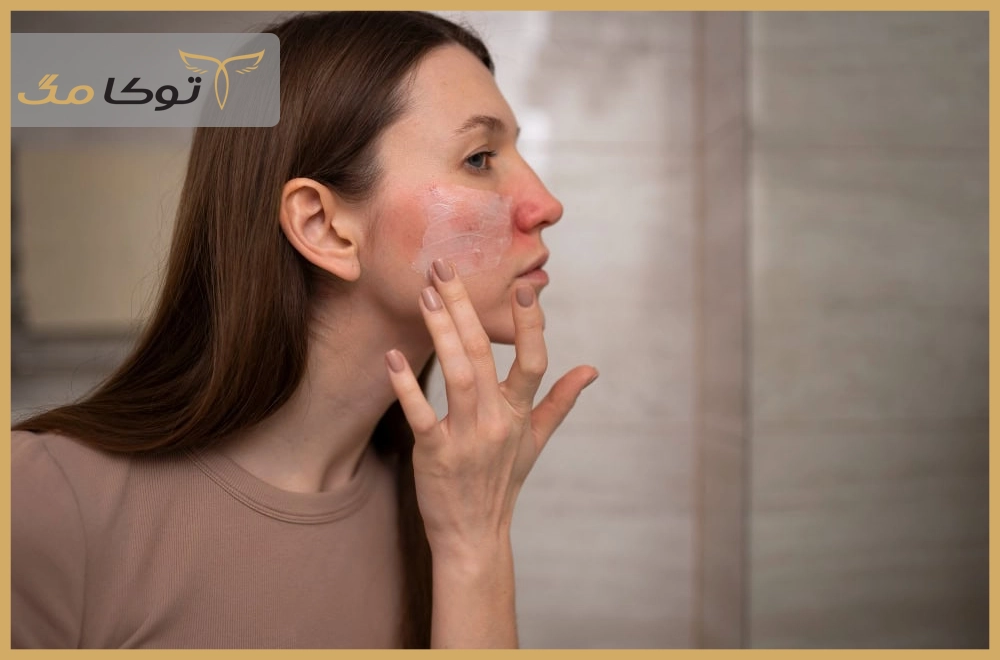 دلایل شایع قرمزی پوست صورت