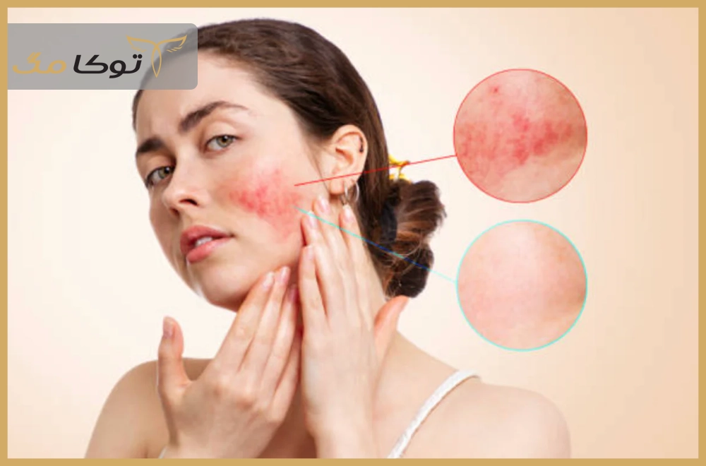 درمان خانگی قرمزی پوست صورت