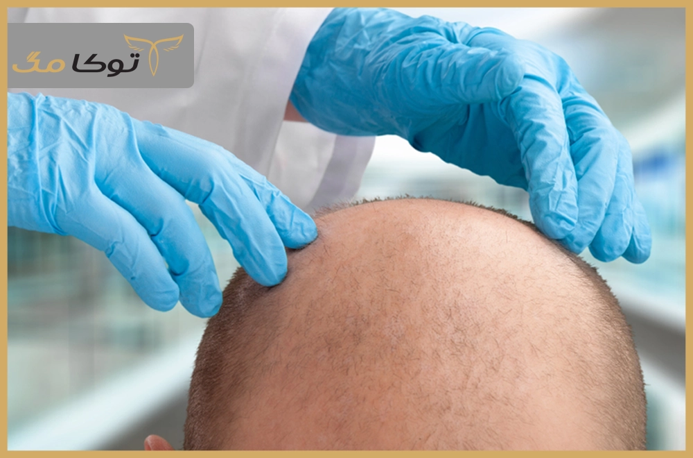 روشهای تشخیص علت ریزش غیرطبیعی موها