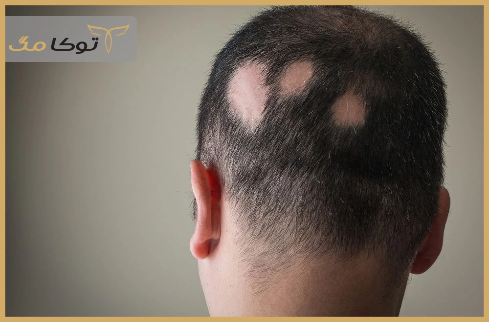 علائم هشداردهنده ریزش موقت یا دائم مو