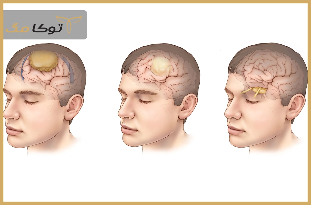 تومور مغزی چیست؟